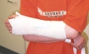 brokenarm_arm.jpg